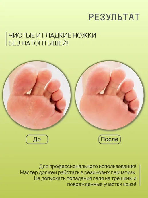 Sagitta Кератолитик для удаления мозолей, - гель, фото 4